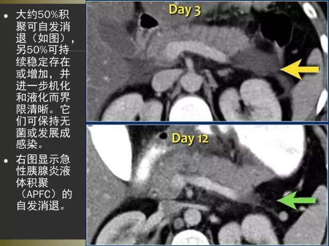 【PPT】急性胰腺炎亚特兰大分类2012年修订版