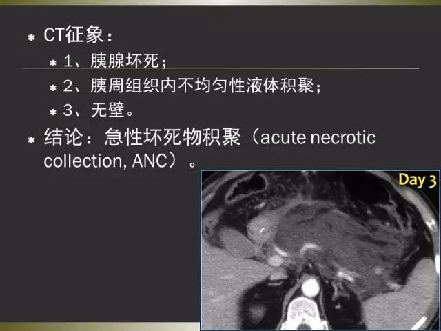 【PPT】急性胰腺炎亚特兰大分类2012年修订版
