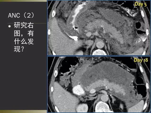 【PPT】急性胰腺炎亚特兰大分类2012年修订版