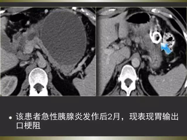 【PPT】急性胰腺炎亚特兰大分类2012年修订版