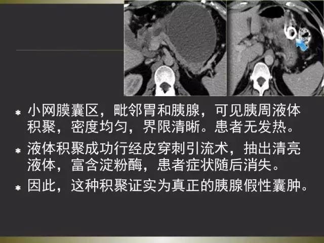 【PPT】急性胰腺炎亚特兰大分类2012年修订版
