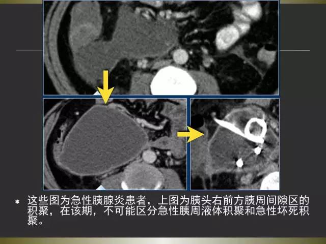【PPT】急性胰腺炎亚特兰大分类2012年修订版