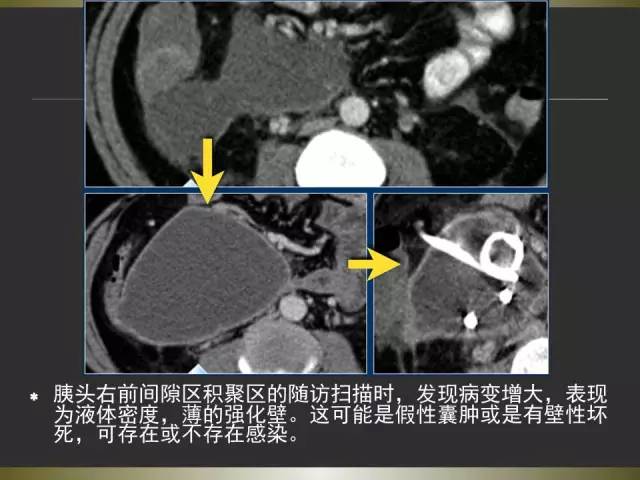 【PPT】急性胰腺炎亚特兰大分类2012年修订版