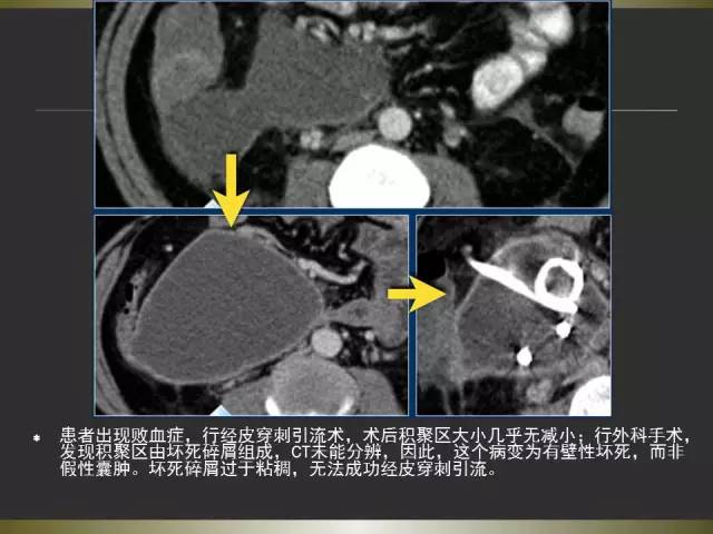 【PPT】急性胰腺炎亚特兰大分类2012年修订版