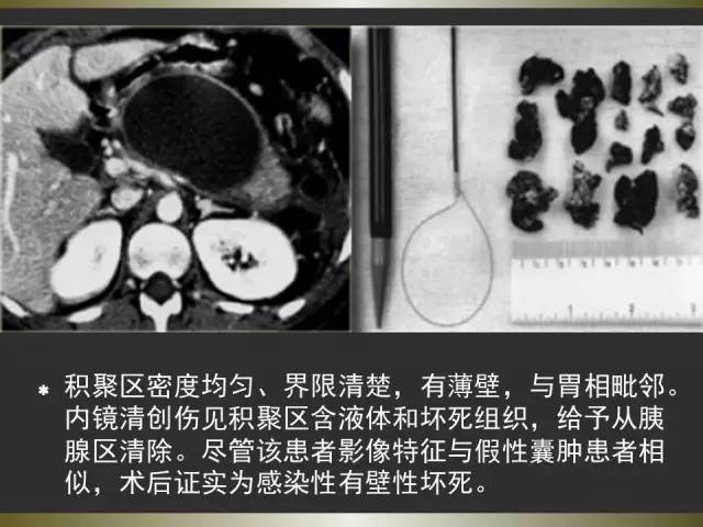 【PPT】急性胰腺炎亚特兰大分类2012年修订版