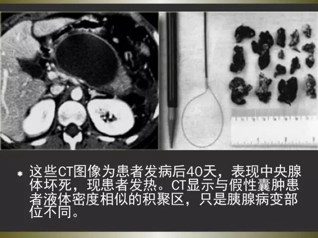 【PPT】急性胰腺炎亚特兰大分类2012年修订版