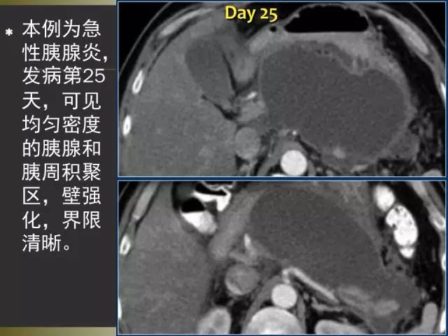 【PPT】急性胰腺炎亚特兰大分类2012年修订版