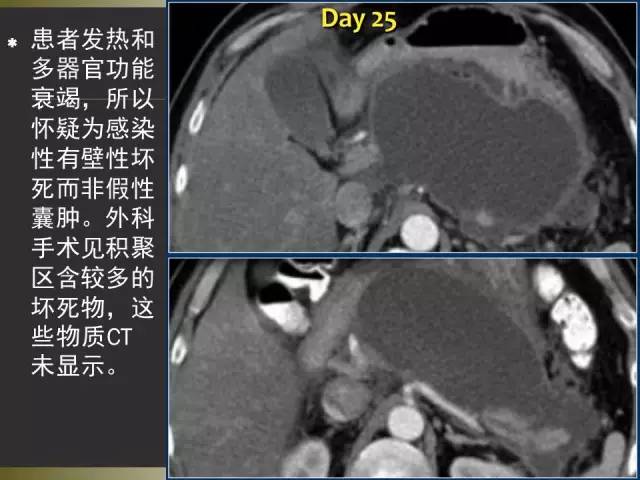 【PPT】急性胰腺炎亚特兰大分类2012年修订版