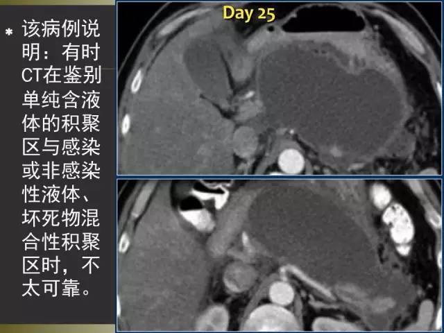 【PPT】急性胰腺炎亚特兰大分类2012年修订版