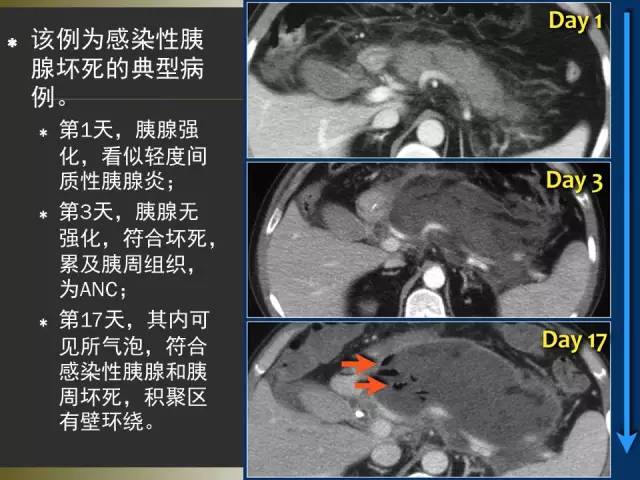 【PPT】急性胰腺炎亚特兰大分类2012年修订版
