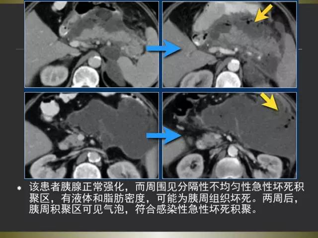 【PPT】急性胰腺炎亚特兰大分类2012年修订版