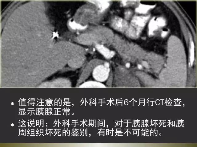 【PPT】急性胰腺炎亚特兰大分类2012年修订版