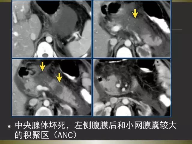 【PPT】急性胰腺炎亚特兰大分类2012年修订版