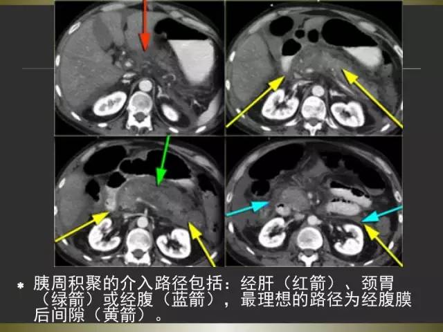 【PPT】急性胰腺炎亚特兰大分类2012年修订版