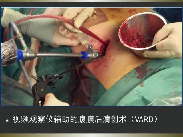 【PPT】急性胰腺炎亚特兰大分类2012年修订版