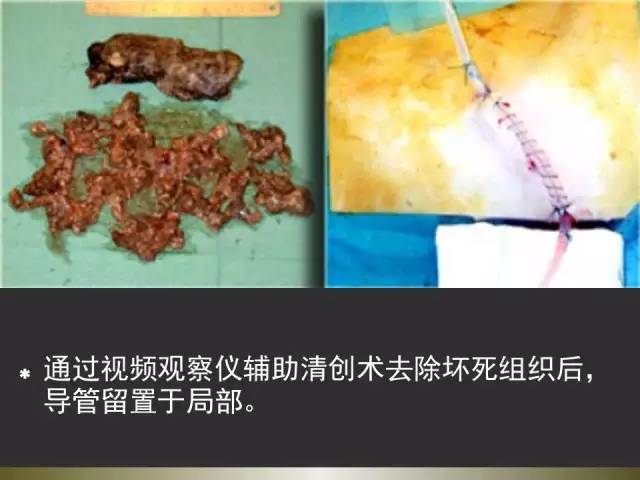 【PPT】急性胰腺炎亚特兰大分类2012年修订版