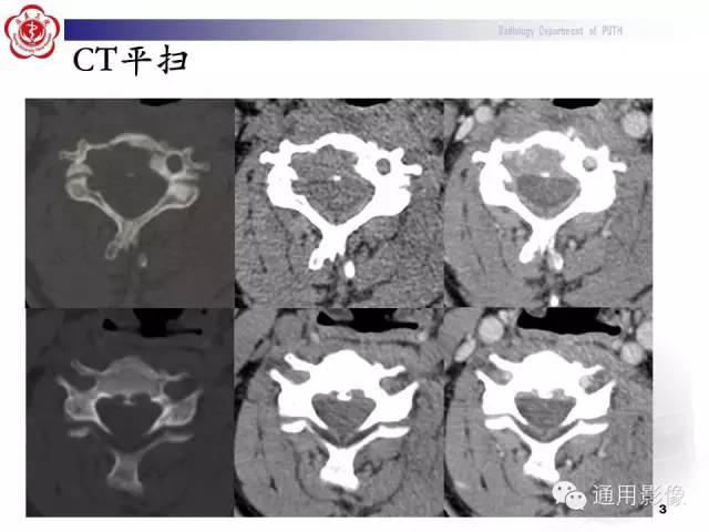 【病例】颈椎嗜酸性肉芽肿1例CT及MR影像表现