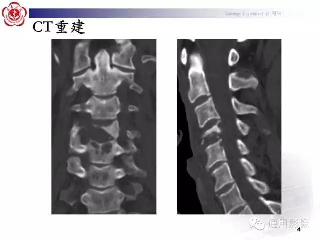 【病例】颈椎嗜酸性肉芽肿1例CT及MR影像表现