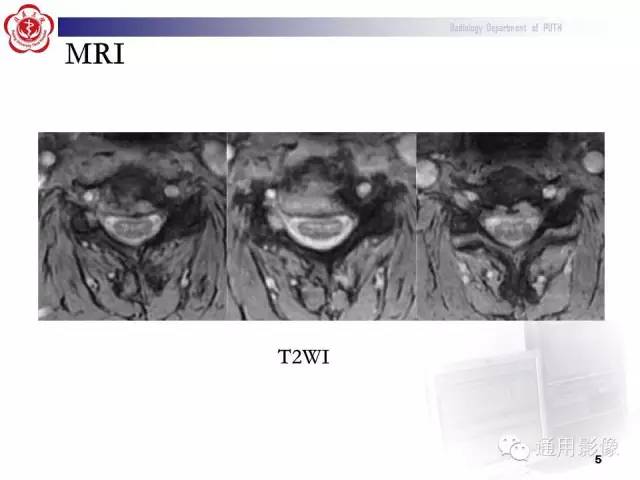 【病例】颈椎嗜酸性肉芽肿1例CT及MR影像表现
