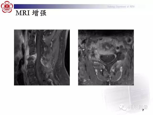 【病例】颈椎嗜酸性肉芽肿1例CT及MR影像表现