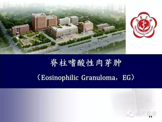 【病例】颈椎嗜酸性肉芽肿1例CT及MR影像表现