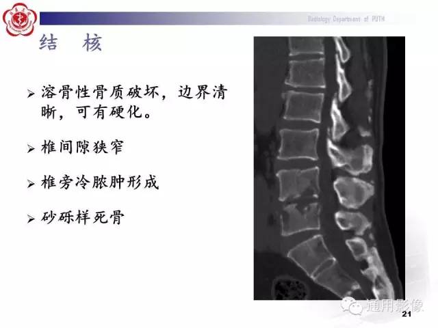【病例】颈椎嗜酸性肉芽肿1例CT及MR影像表现
