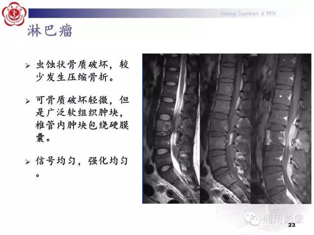 【病例】颈椎嗜酸性肉芽肿1例CT及MR影像表现