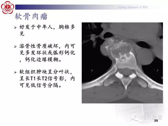 【病例】颈椎嗜酸性肉芽肿1例CT及MR影像表现