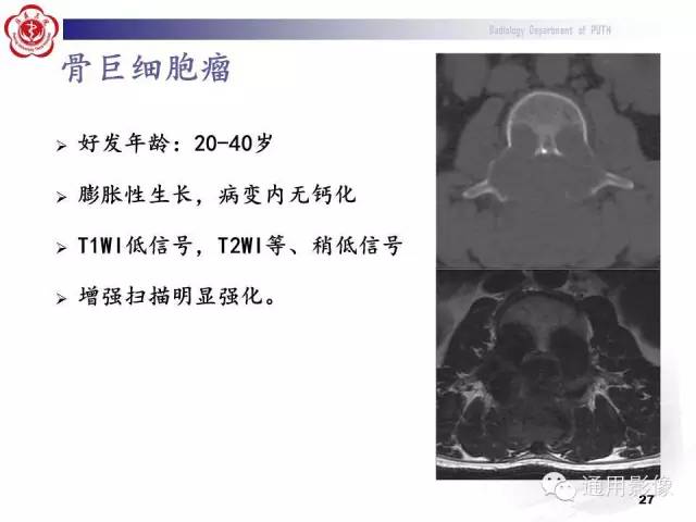【病例】颈椎嗜酸性肉芽肿1例CT及MR影像表现