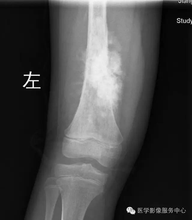 【病例】股骨骨肉瘤1例X线及CT影像表现