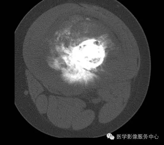 【病例】股骨骨肉瘤1例X线及CT影像表现 【病例】股骨骨肉瘤1例X线及CT影像表现