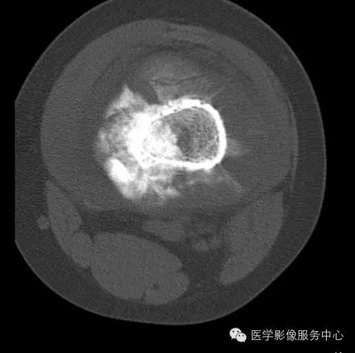 【病例】股骨骨肉瘤1例X线及CT影像表现 【病例】股骨骨肉瘤1例X线及CT影像表现