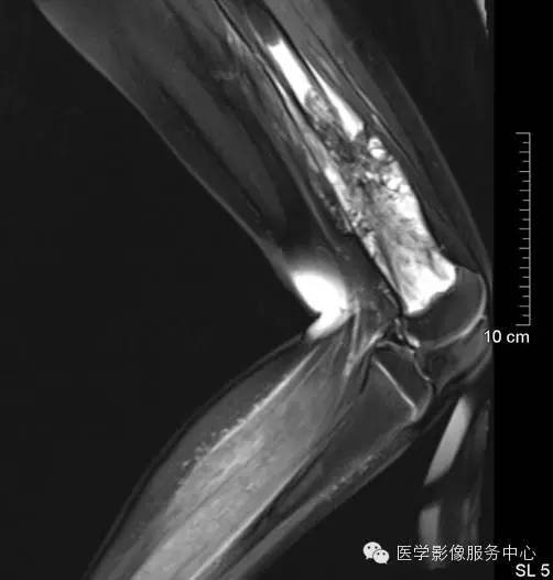 【病例】股骨骨肉瘤1例X线及CT影像表现 【病例】股骨骨肉瘤1例X线及CT影像表现