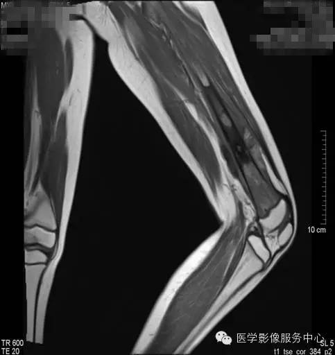 【病例】股骨骨肉瘤1例X线及CT影像表现 【病例】股骨骨肉瘤1例X线及CT影像表现