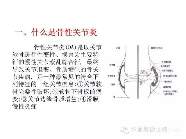 【PPT】深刻理解膝关节骨性关节炎