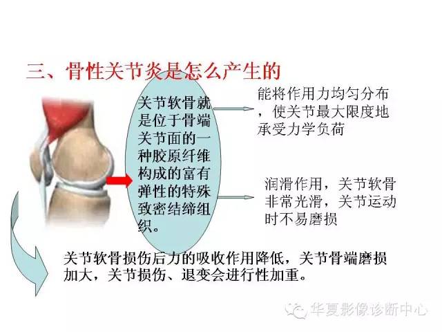 【PPT】深刻理解膝关节骨性关节炎