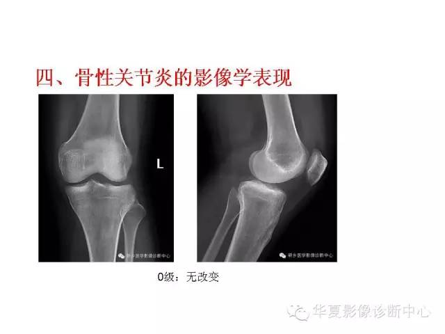 【PPT】深刻理解膝关节骨性关节炎