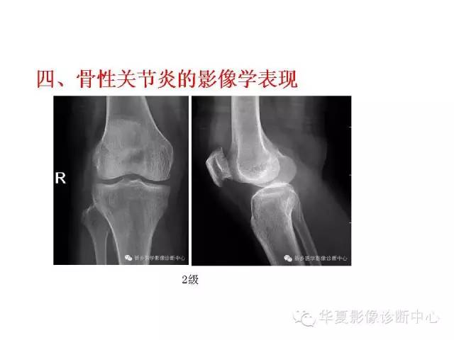 【PPT】深刻理解膝关节骨性关节炎