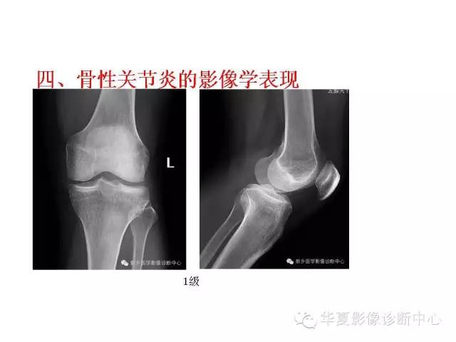 【PPT】深刻理解膝关节骨性关节炎