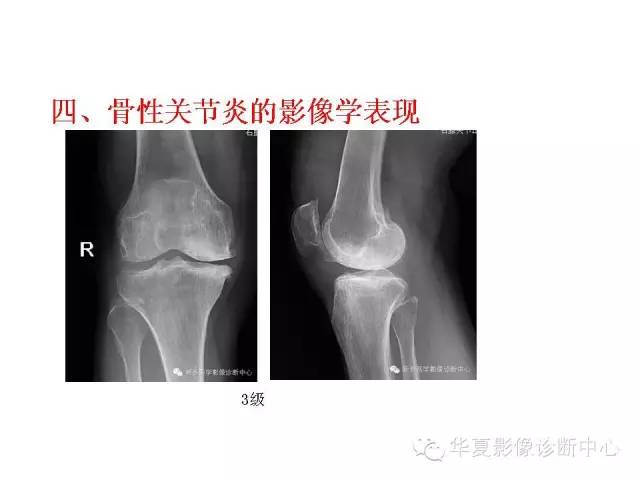 【PPT】深刻理解膝关节骨性关节炎
