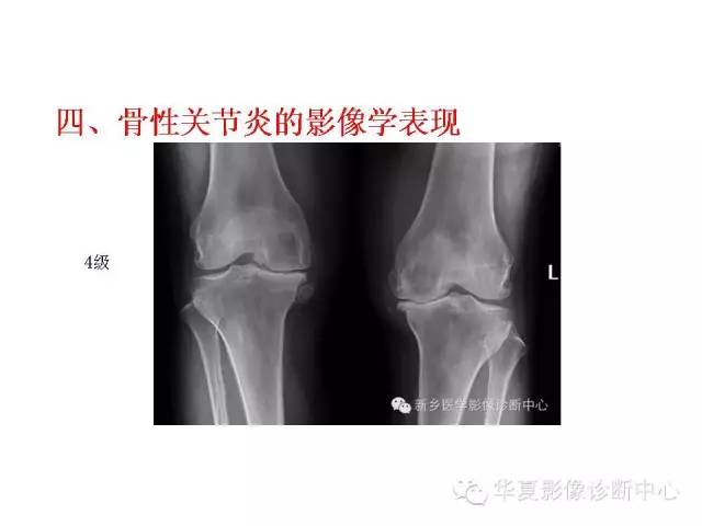 【PPT】深刻理解膝关节骨性关节炎