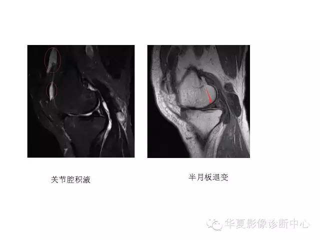 【PPT】深刻理解膝关节骨性关节炎