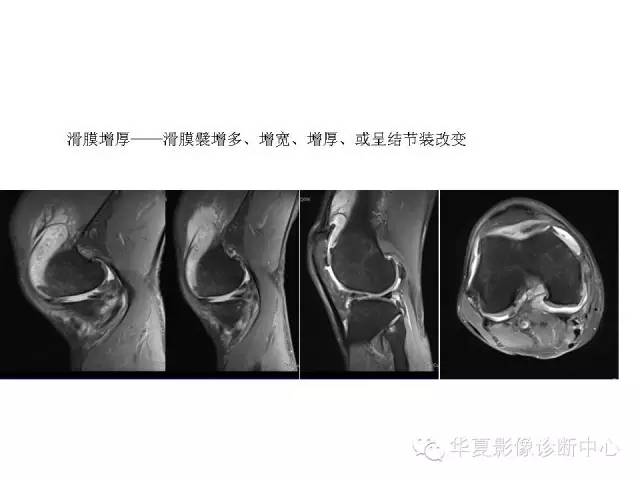 【PPT】深刻理解膝关节骨性关节炎