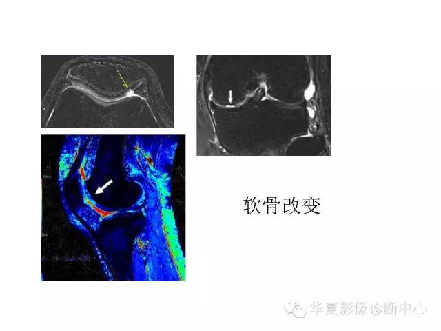 【PPT】深刻理解膝关节骨性关节炎