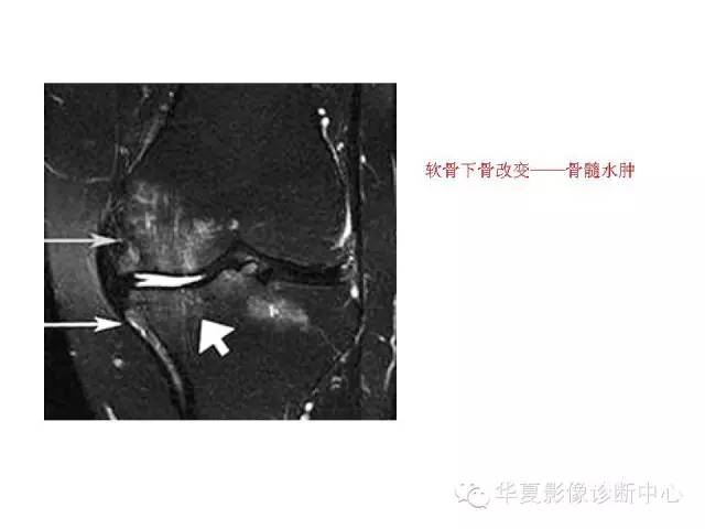 【PPT】深刻理解膝关节骨性关节炎