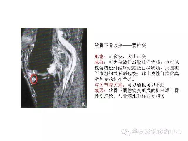 【PPT】深刻理解膝关节骨性关节炎