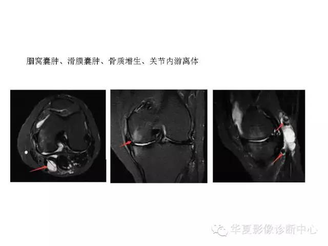【PPT】深刻理解膝关节骨性关节炎