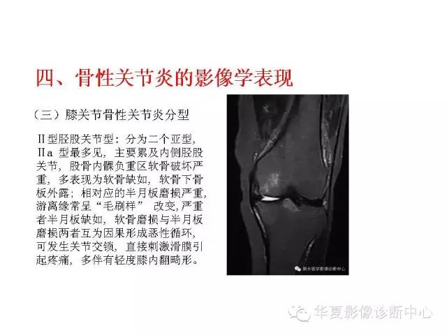 【PPT】深刻理解膝关节骨性关节炎