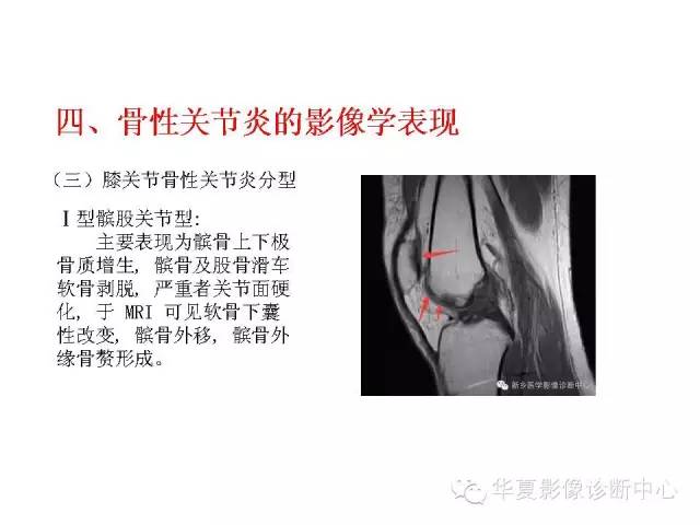 【PPT】深刻理解膝关节骨性关节炎