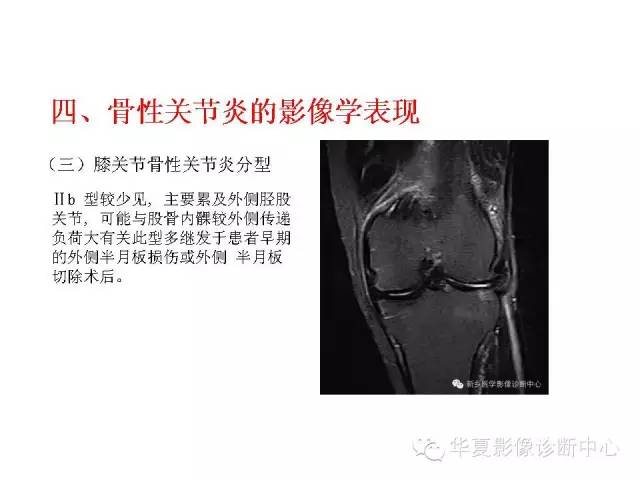 【PPT】深刻理解膝关节骨性关节炎